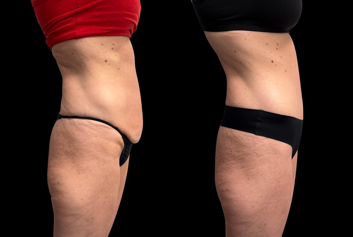 Tummy Tuck Before & After Gallery - Patient 138485 - Image 6