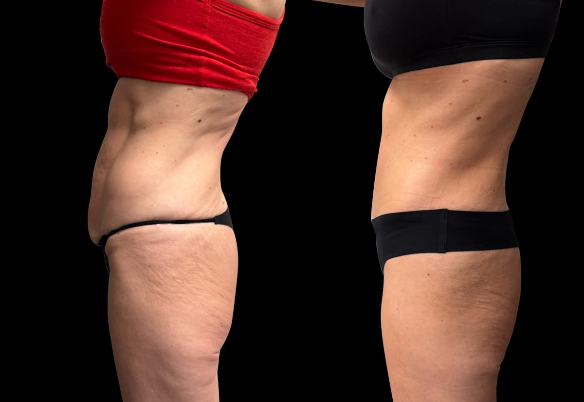 Tummy Tuck Before & After Gallery - Patient 138485 - Image 4