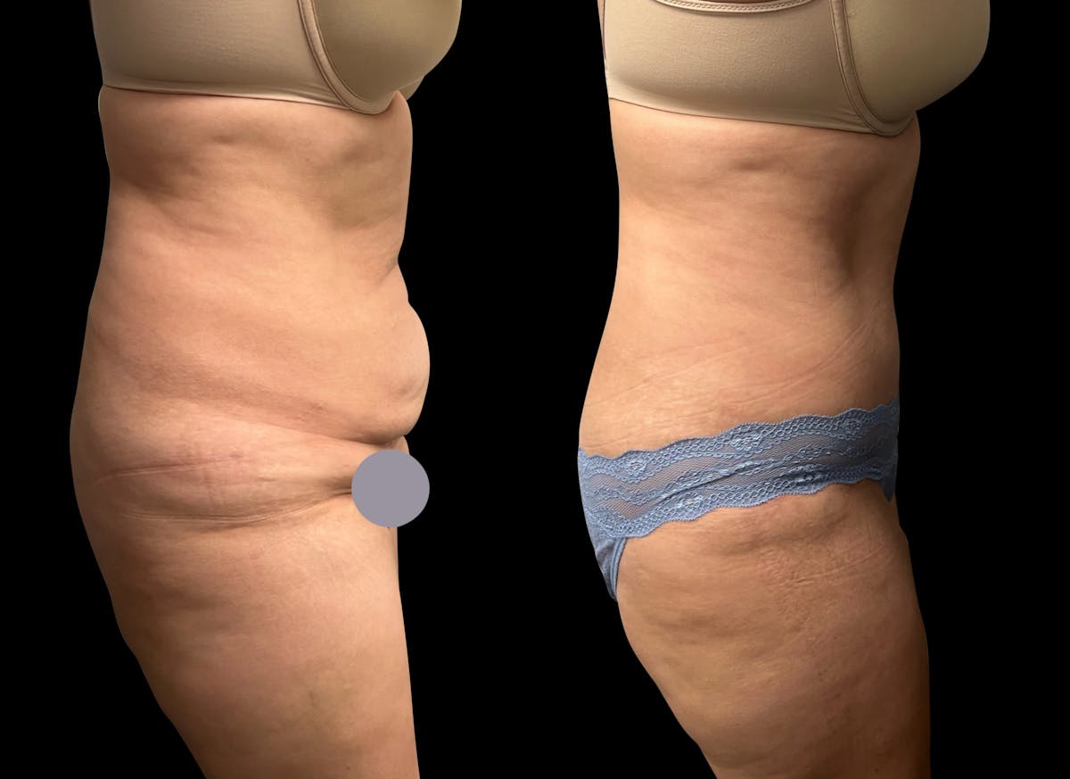 Tummy Tuck Before & After Gallery - Patient 311992 - Image 5
