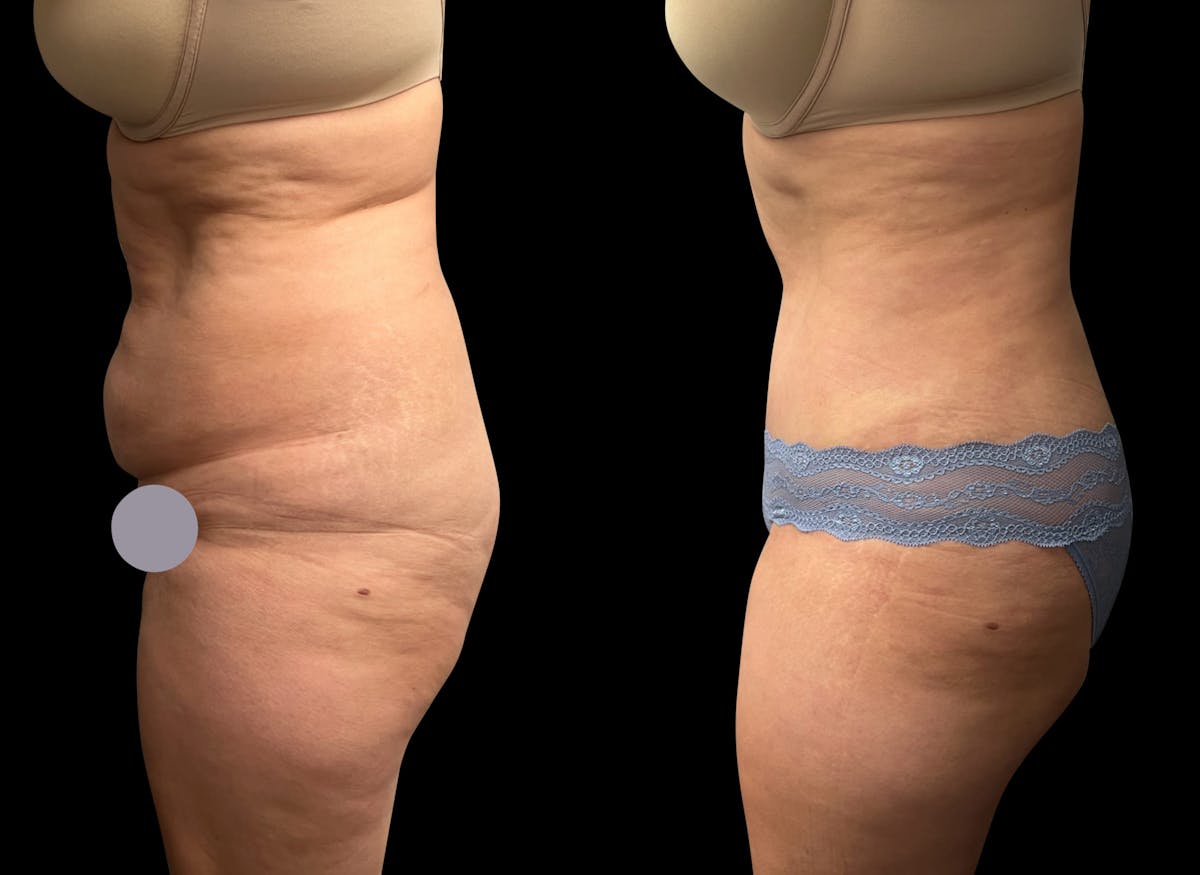 Tummy Tuck Before & After Gallery - Patient 311992 - Image 3