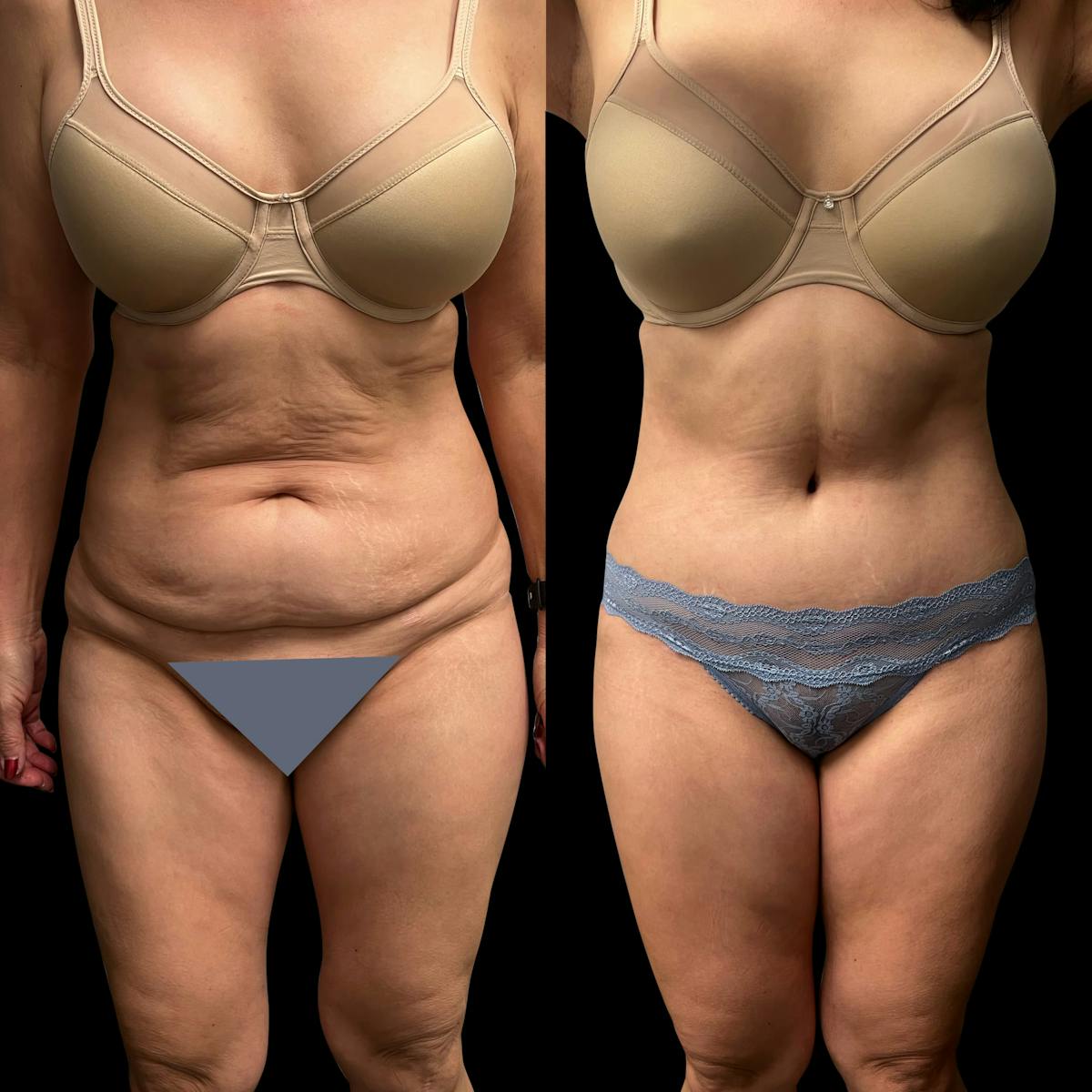 Tummy Tuck Before & After Gallery - Patient 311992 - Image 1