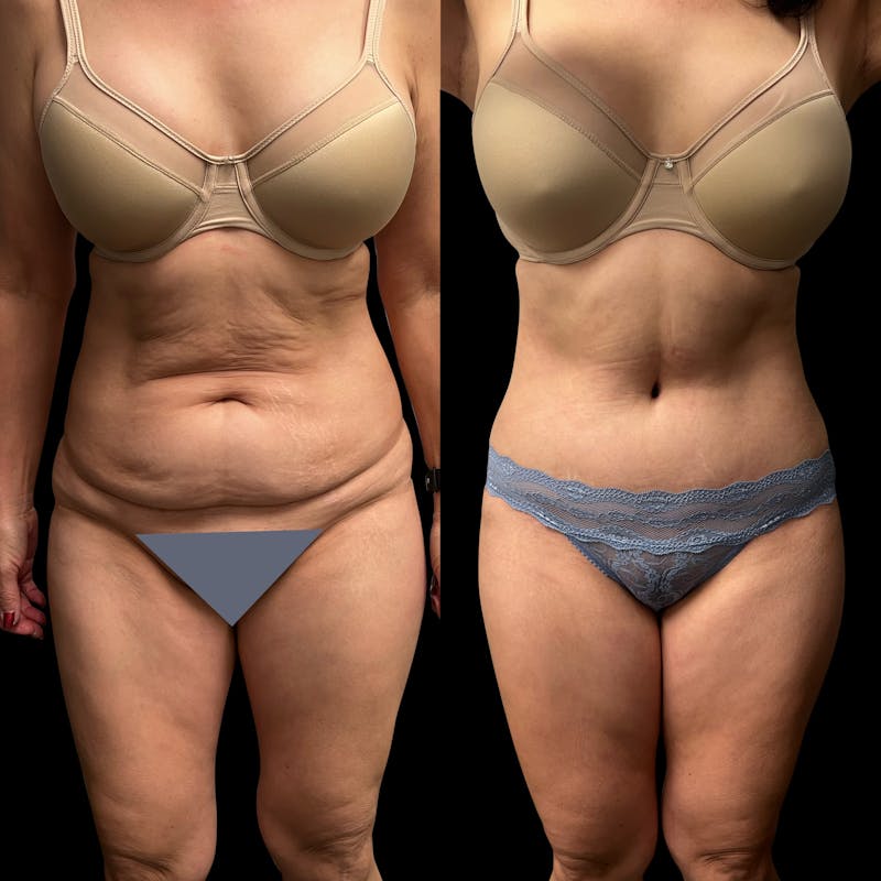 Tummy Tuck Before & After Gallery - Patient 311992 - Image 1