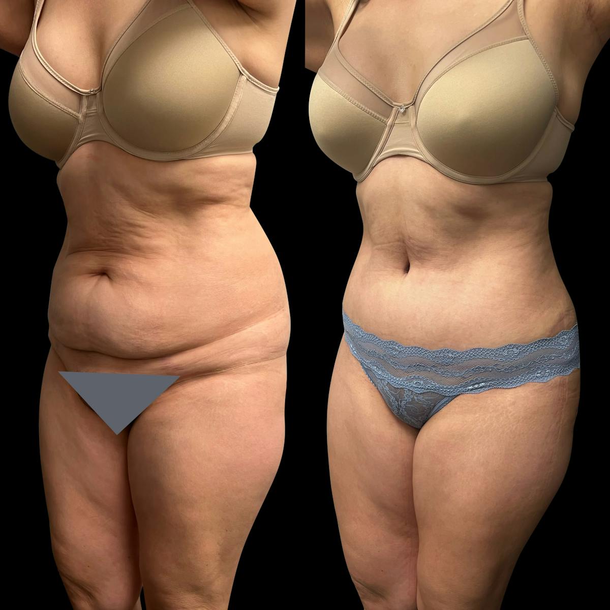 Tummy Tuck Before & After Gallery - Patient 311992 - Image 2