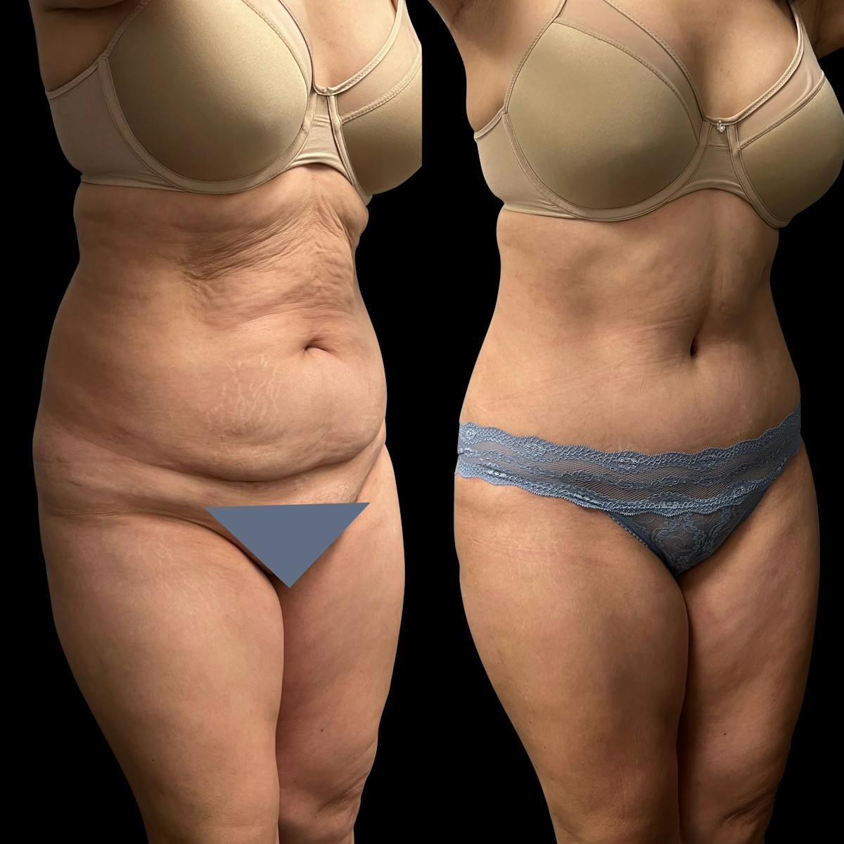 Tummy Tuck Before & After Gallery - Patient 311992 - Image 4