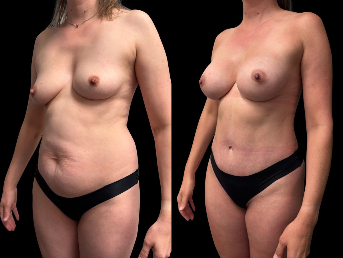 Tummy Tuck Before & After Gallery - Patient 423143 - Image 3