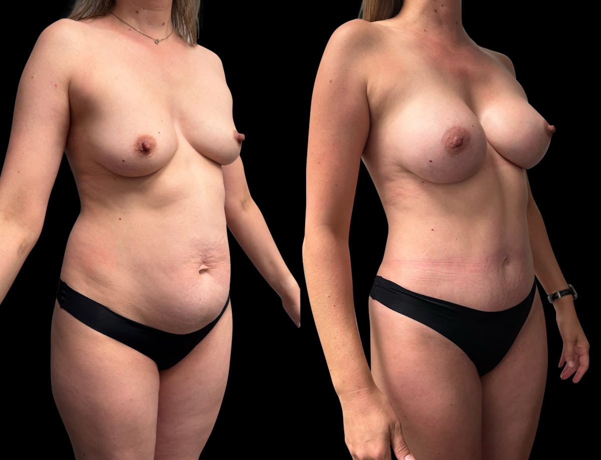 Tummy Tuck Before & After Gallery - Patient 423143 - Image 2