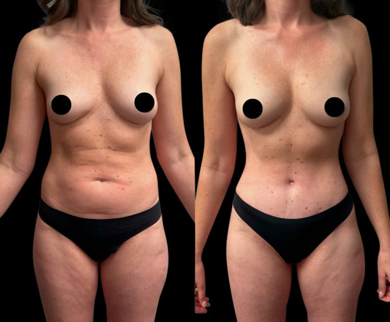 Tummy Tuck Before & After Gallery - Patient 186442 - Image 1
