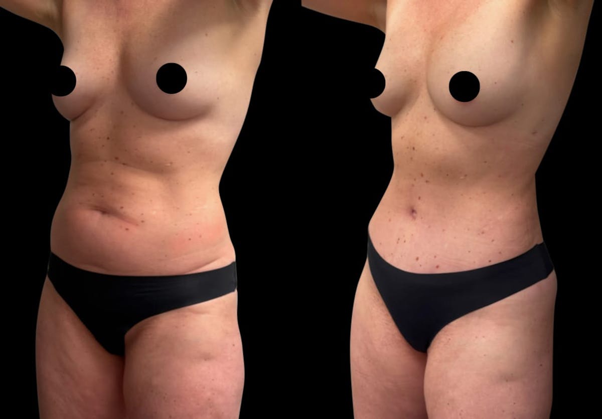 Tummy Tuck Before & After Gallery - Patient 186442 - Image 4