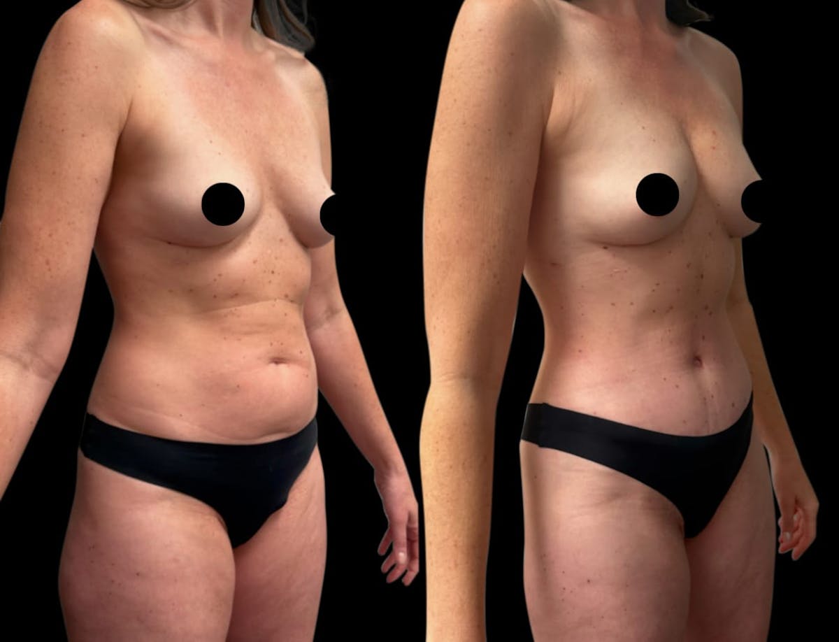 Tummy Tuck Before & After Gallery - Patient 186442 - Image 2