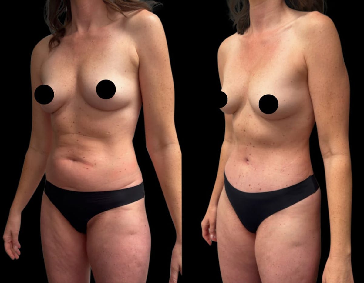 Tummy Tuck Before & After Gallery - Patient 186442 - Image 3