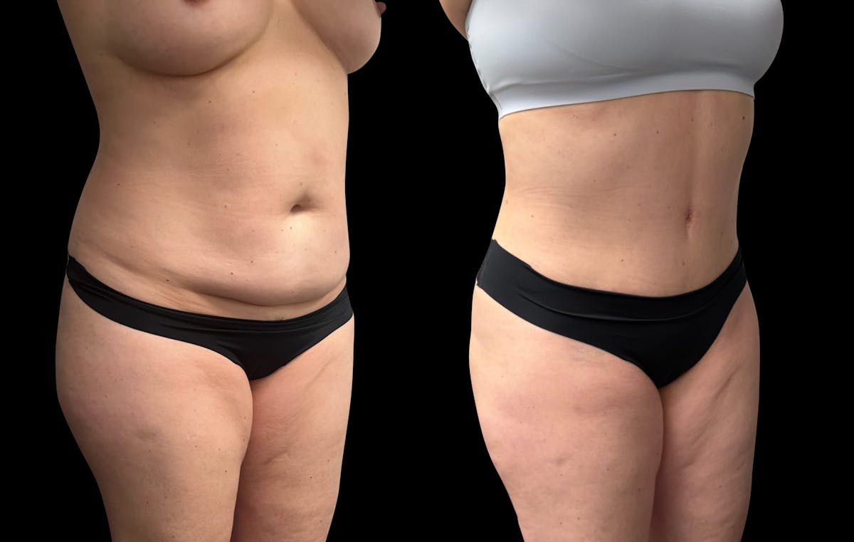 Tummy Tuck Before & After Gallery - Patient 337273 - Image 4