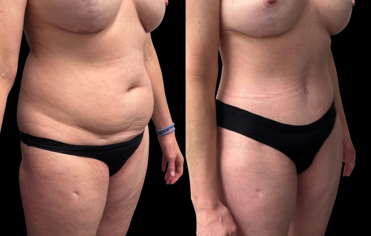 Tummy Tuck Before & After Gallery - Patient 415668 - Image 2