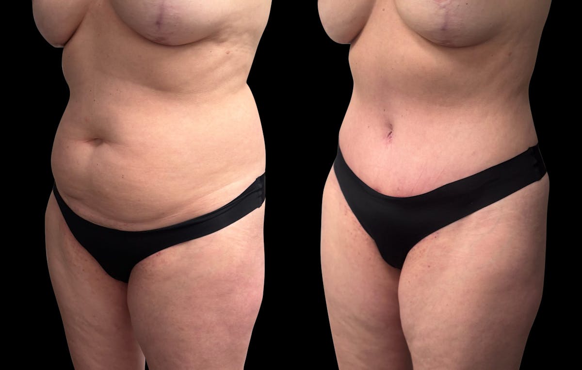 Tummy Tuck Before & After Gallery - Patient 415668 - Image 4