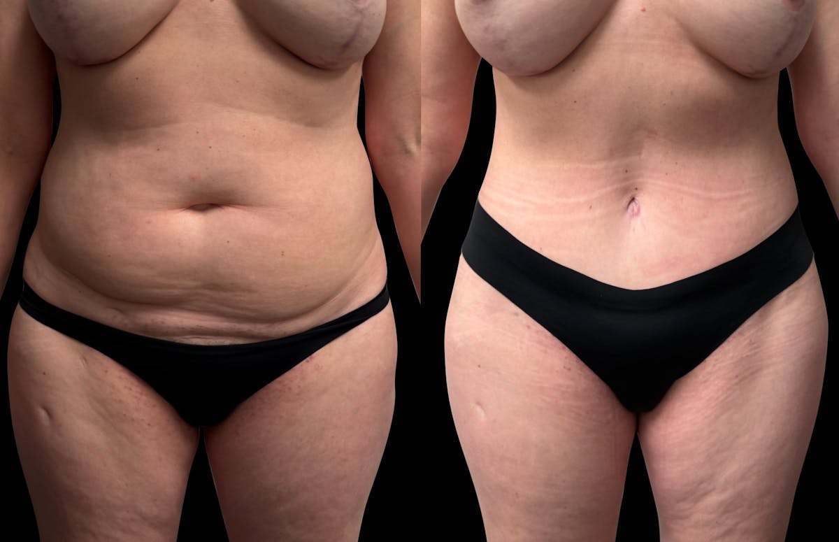 Tummy Tuck Before & After Gallery - Patient 415668 - Image 1