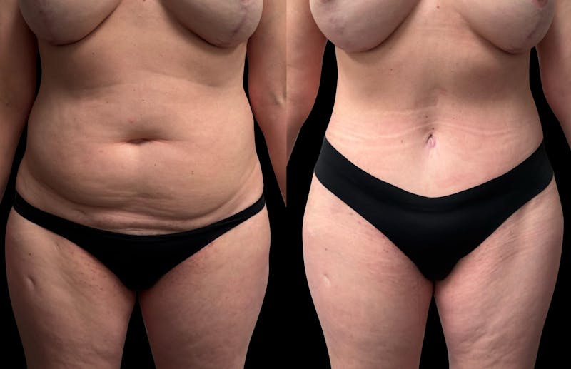 Tummy Tuck Before & After Gallery - Patient 415668 - Image 1