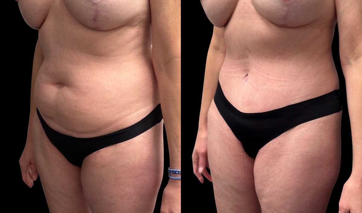 Tummy Tuck Before & After Gallery - Patient 415668 - Image 3