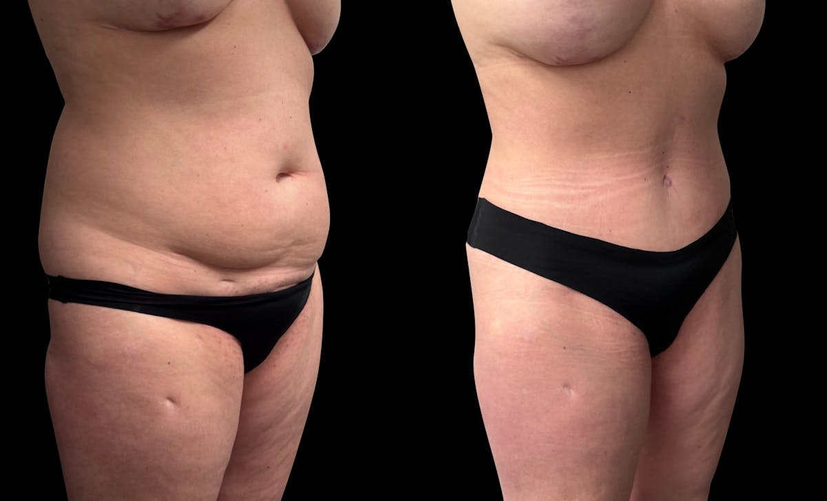 Tummy Tuck Before & After Gallery - Patient 415668 - Image 5
