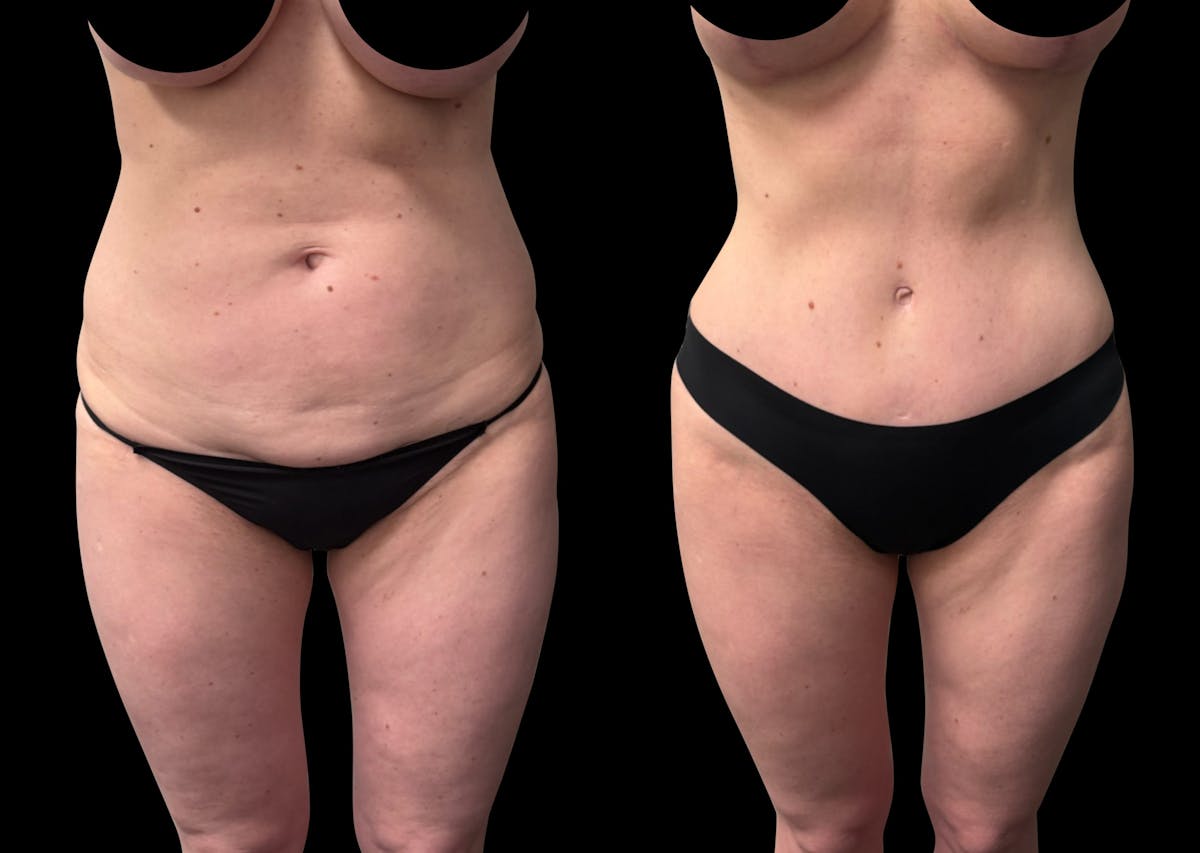 Tummy Tuck Before & After Gallery - Patient 252726 - Image 2