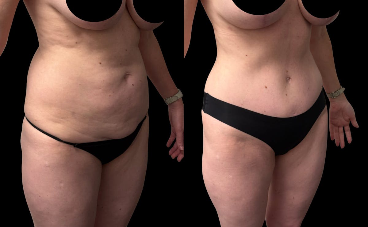 Tummy Tuck Before & After Gallery - Patient 252726 - Image 3