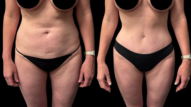 Tummy Tuck Before & After Gallery - Patient 252726 - Image 1