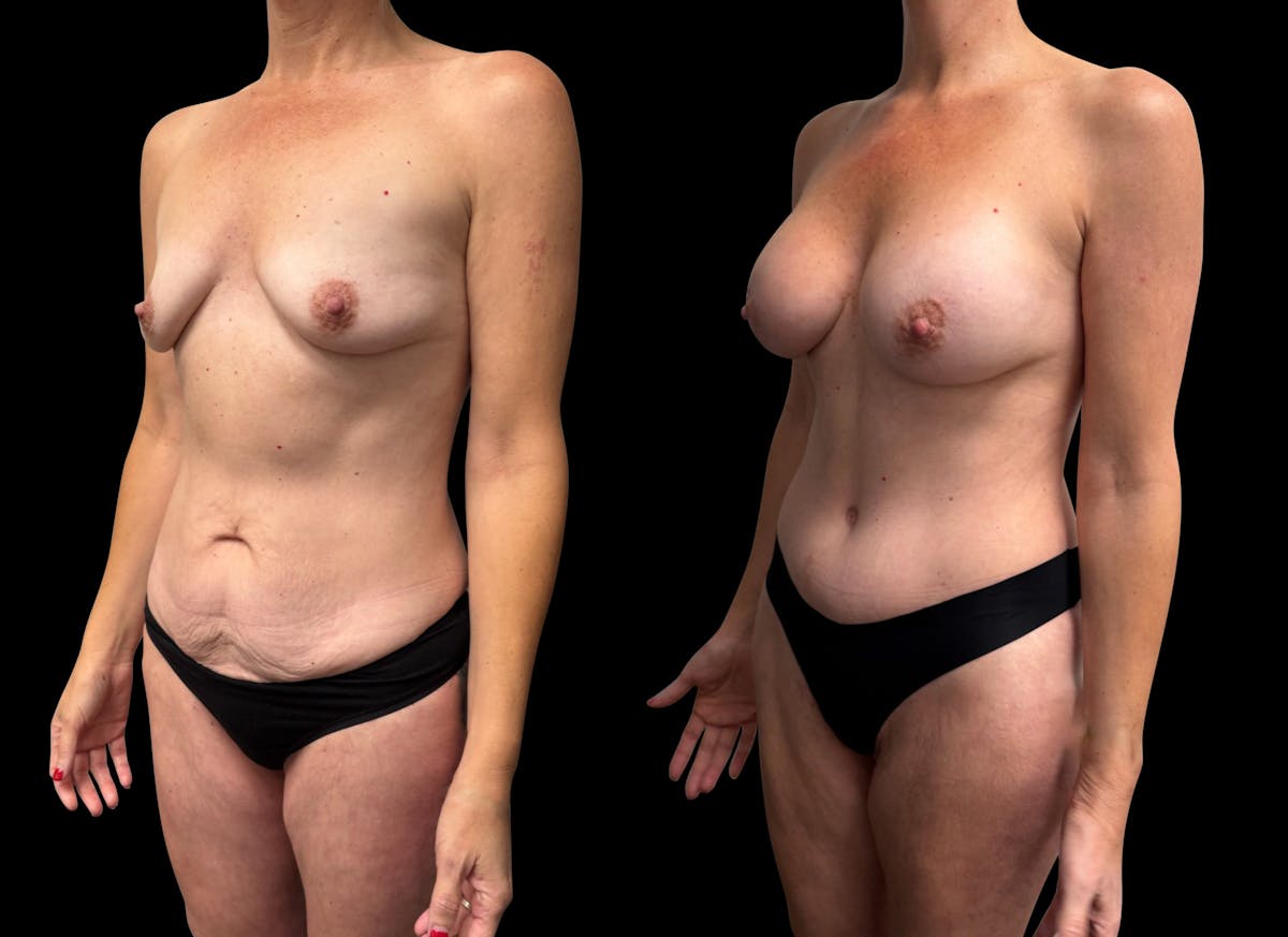 Tummy Tuck Before & After Gallery - Patient 270803 - Image 2