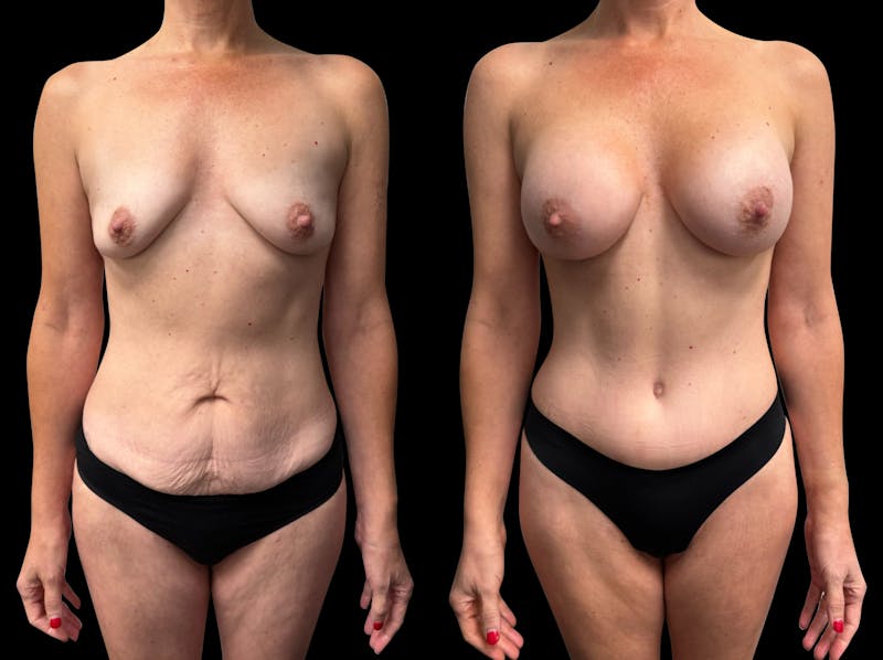 Tummy Tuck Before & After Gallery - Patient 270803 - Image 1
