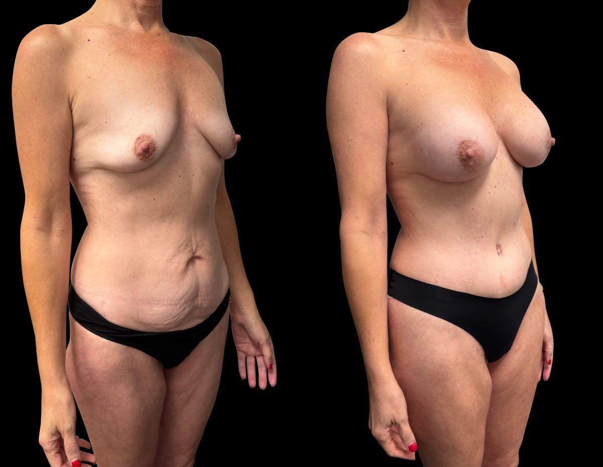 Tummy Tuck Before & After Gallery - Patient 270803 - Image 4