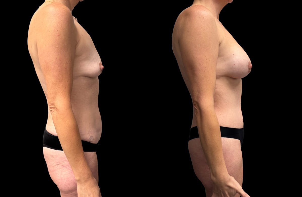 Tummy Tuck Before & After Gallery - Patient 270803 - Image 5