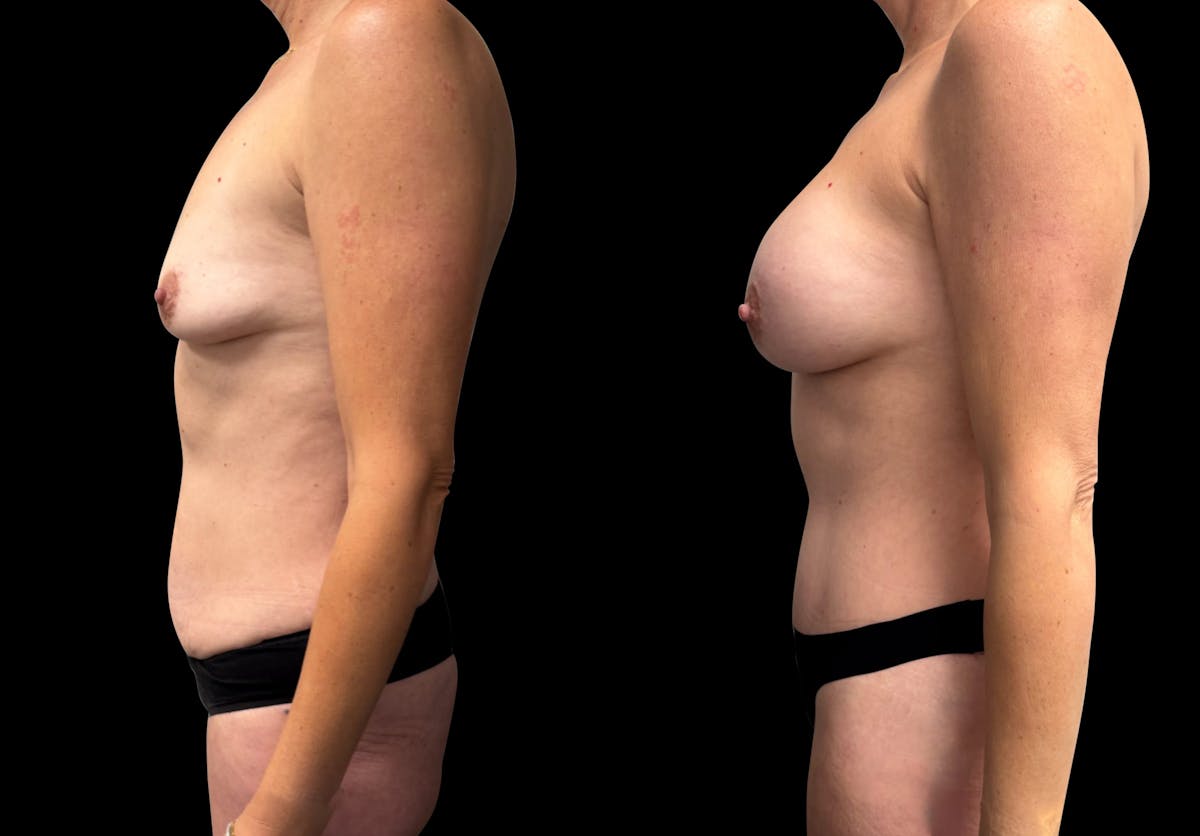 Tummy Tuck Before & After Gallery - Patient 270803 - Image 3
