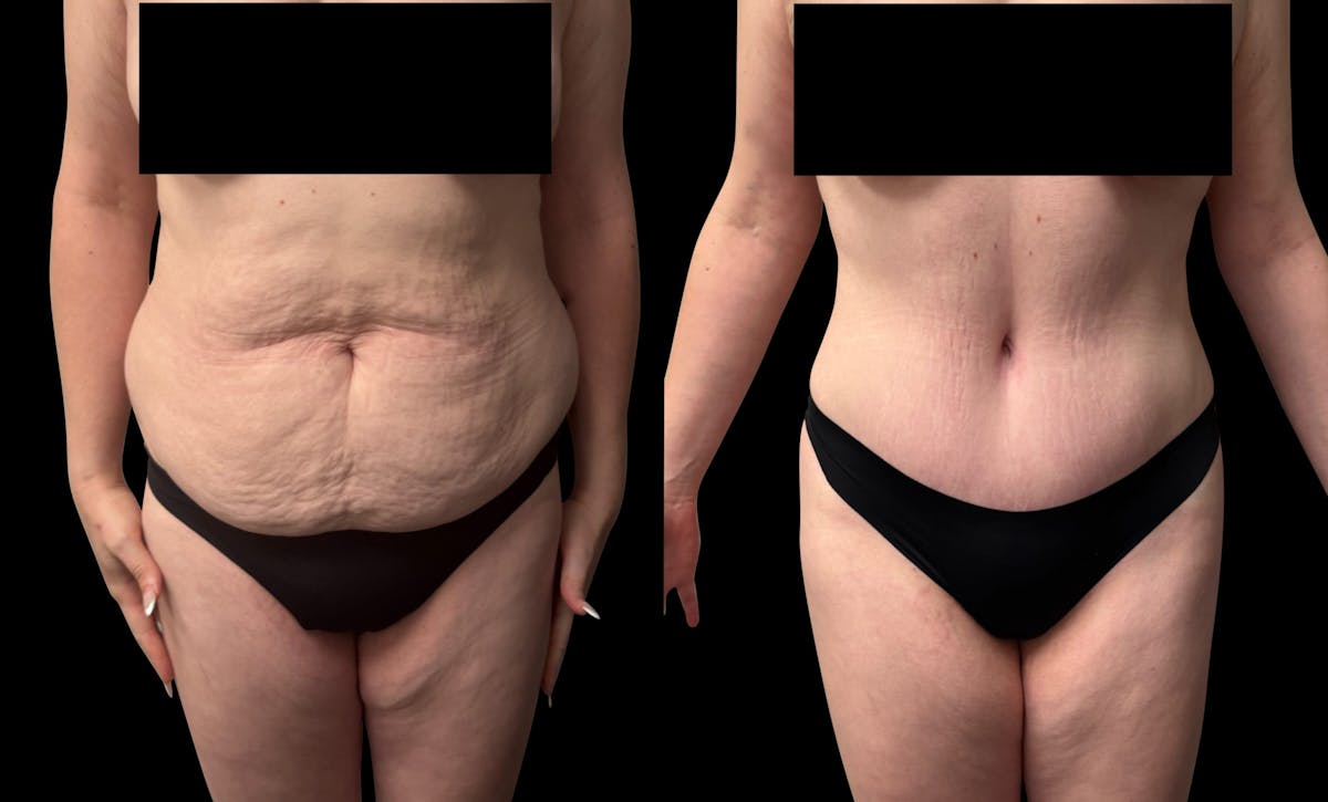 Tummy Tuck Before & After Gallery - Patient 764113 - Image 1