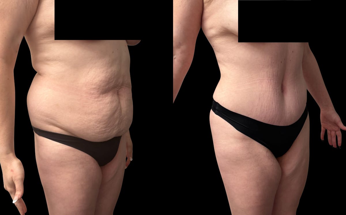 Tummy Tuck Before & After Gallery - Patient 764113 - Image 2