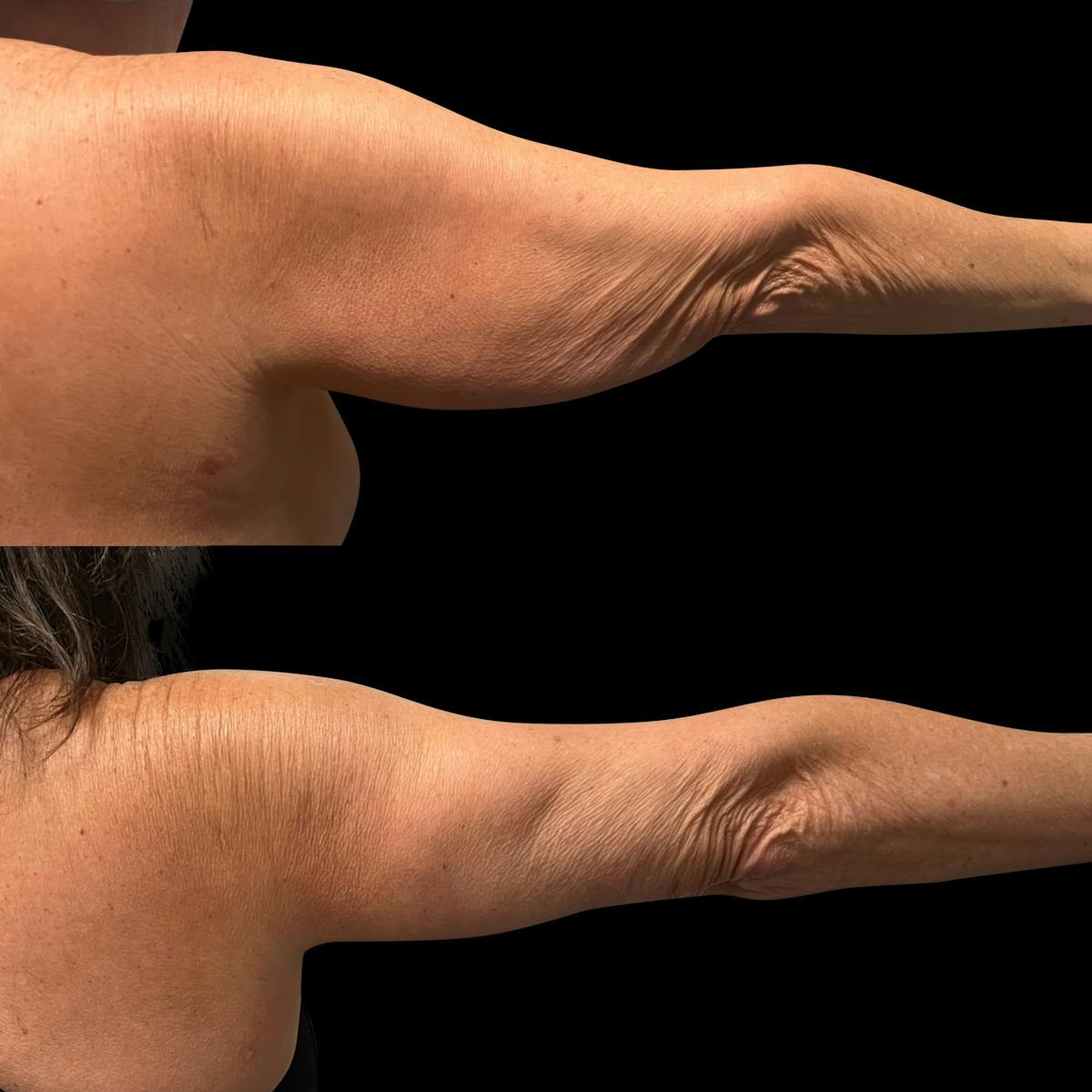 Arm Lift Before & After Gallery - Patient 318025 - Image 4