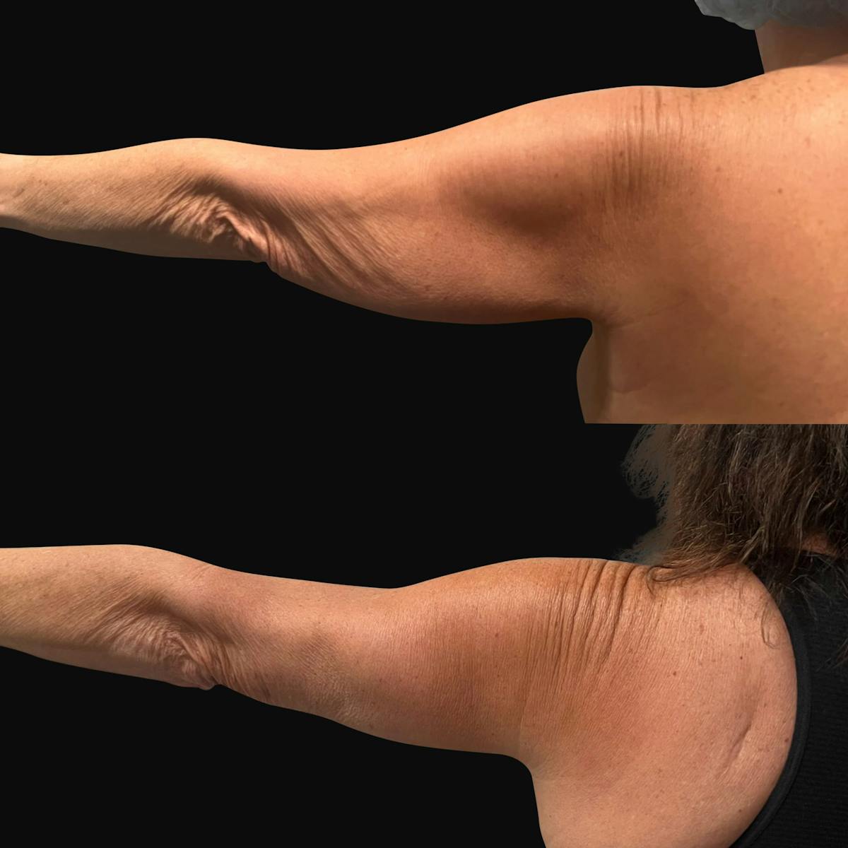Arm Lift Before & After Gallery - Patient 318025 - Image 3