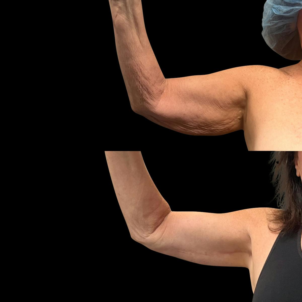 Arm Lift Before & After Gallery - Patient 318025 - Image 2