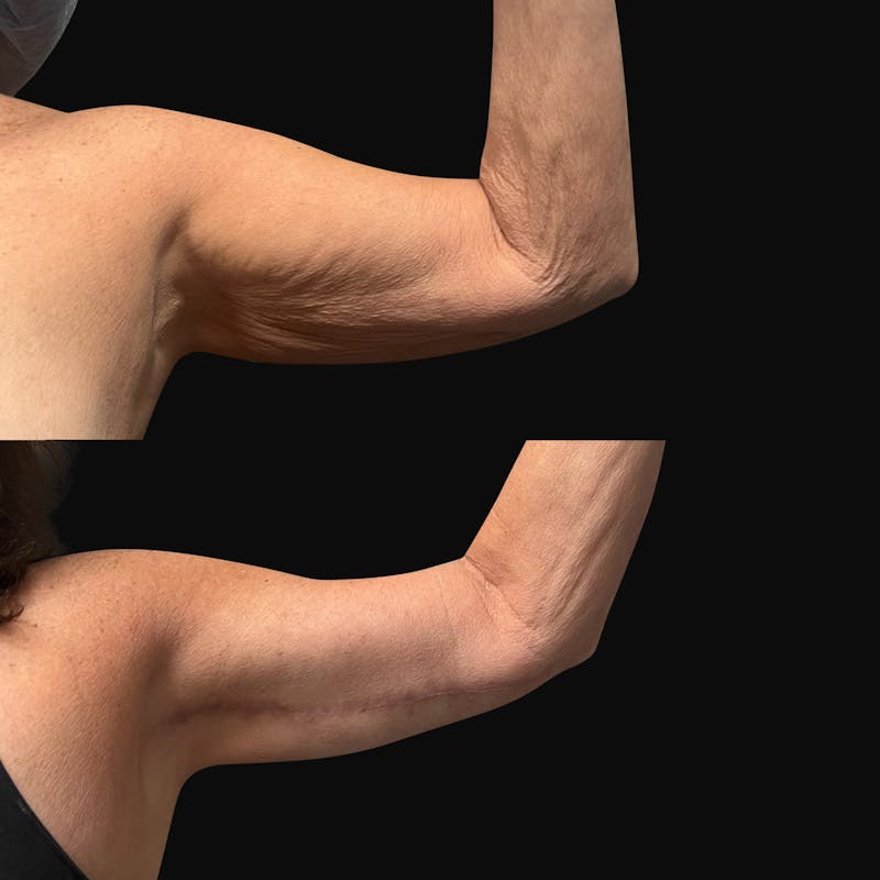 Arm Lift Before & After Gallery - Patient 318025 - Image 1