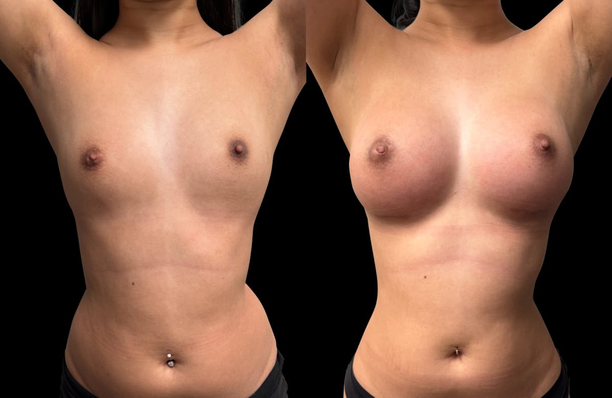 Breast Augmentation Before & After Gallery - Patient 946053 - Image 3