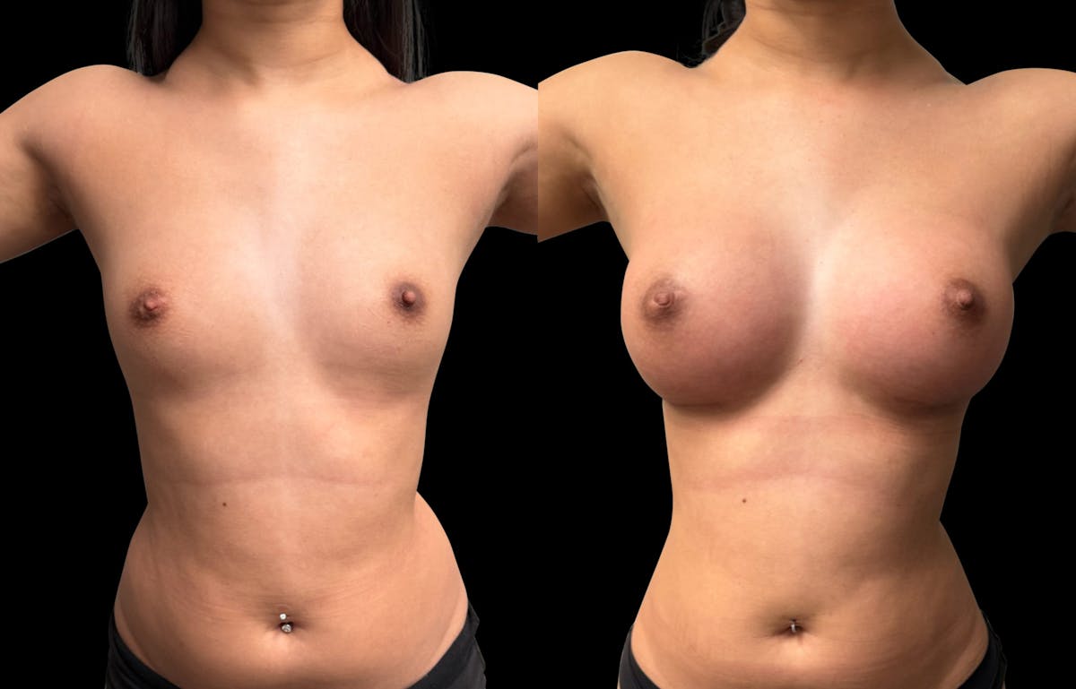 Breast Augmentation Before & After Gallery - Patient 946053 - Image 2