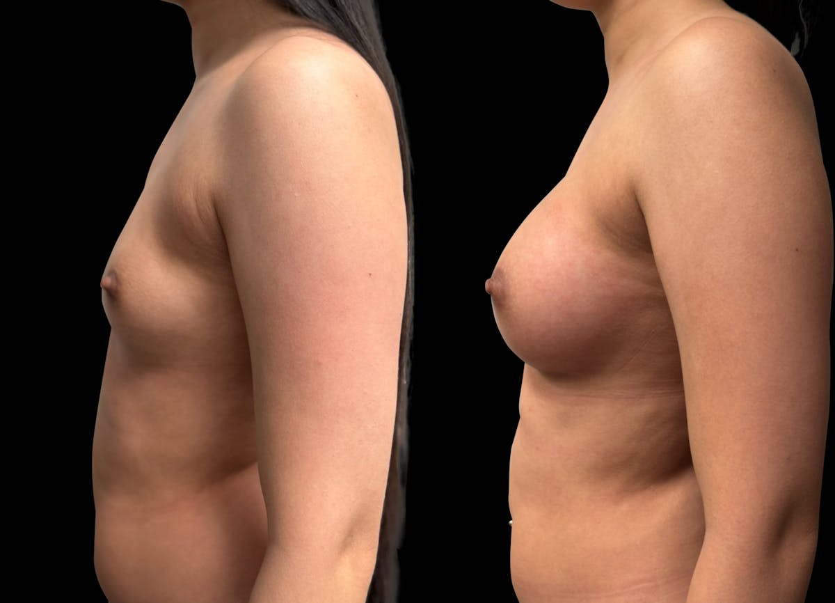 Breast Augmentation Before & After Gallery - Patient 946053 - Image 7