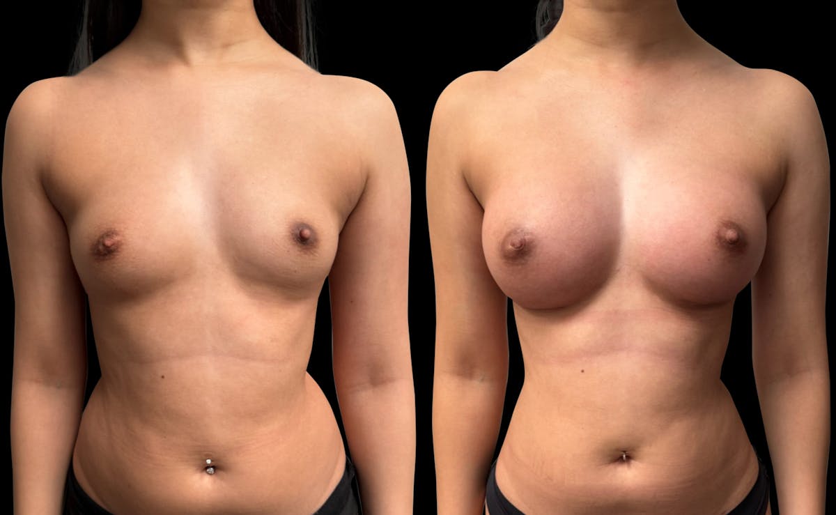 Breast Augmentation Before & After Gallery - Patient 946053 - Image 1