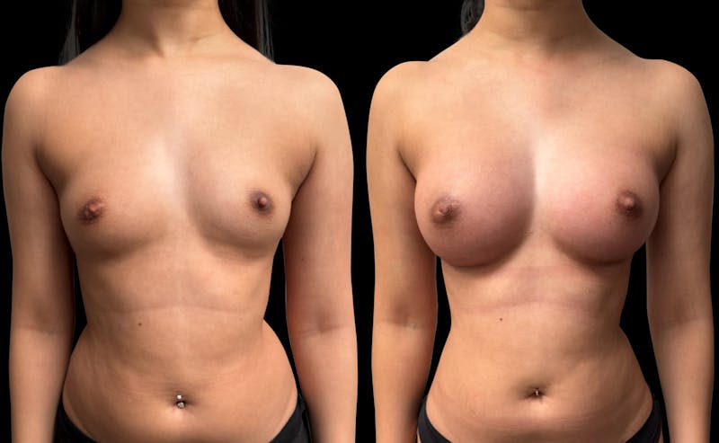 Breast Augmentation Before & After Gallery - Patient 946053 - Image 1