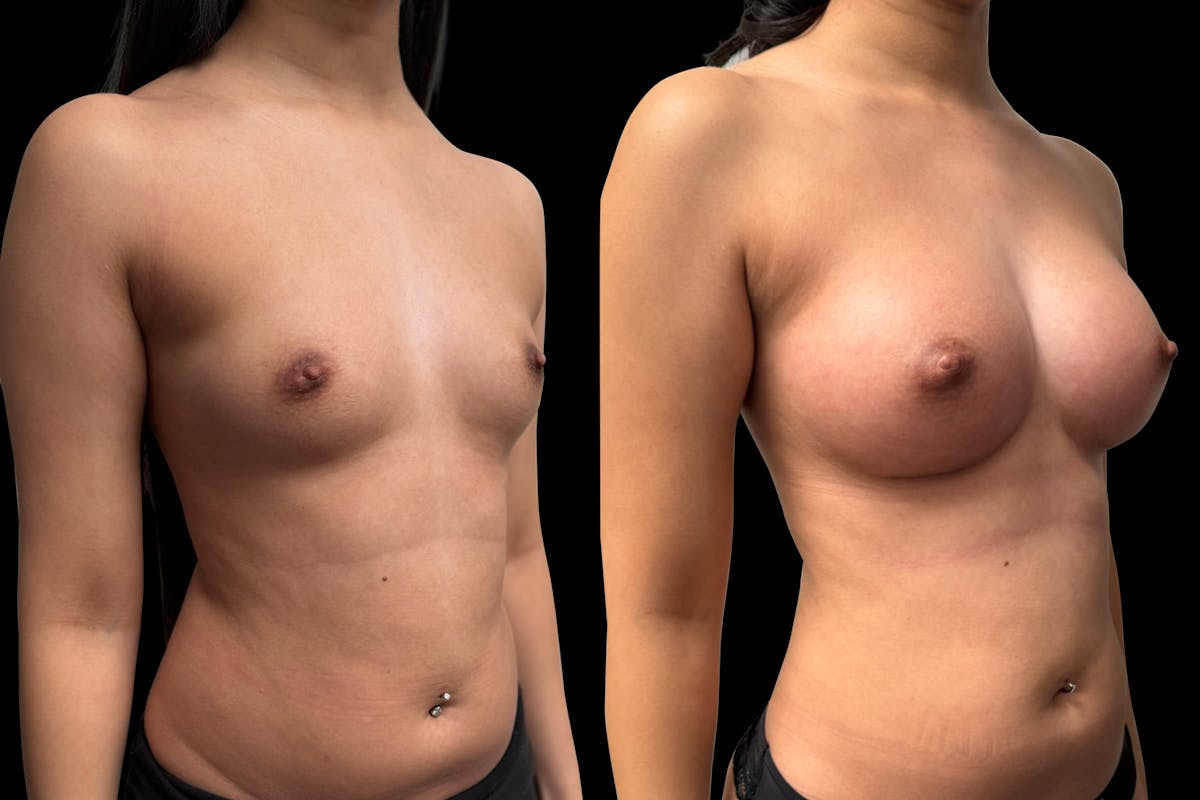Breast Augmentation Before & After Gallery - Patient 946053 - Image 4