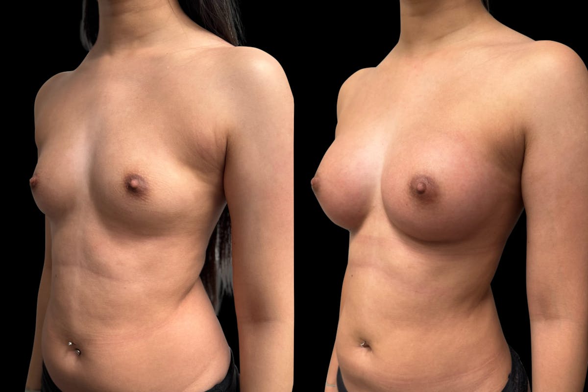Breast Augmentation Before & After Gallery - Patient 946053 - Image 6