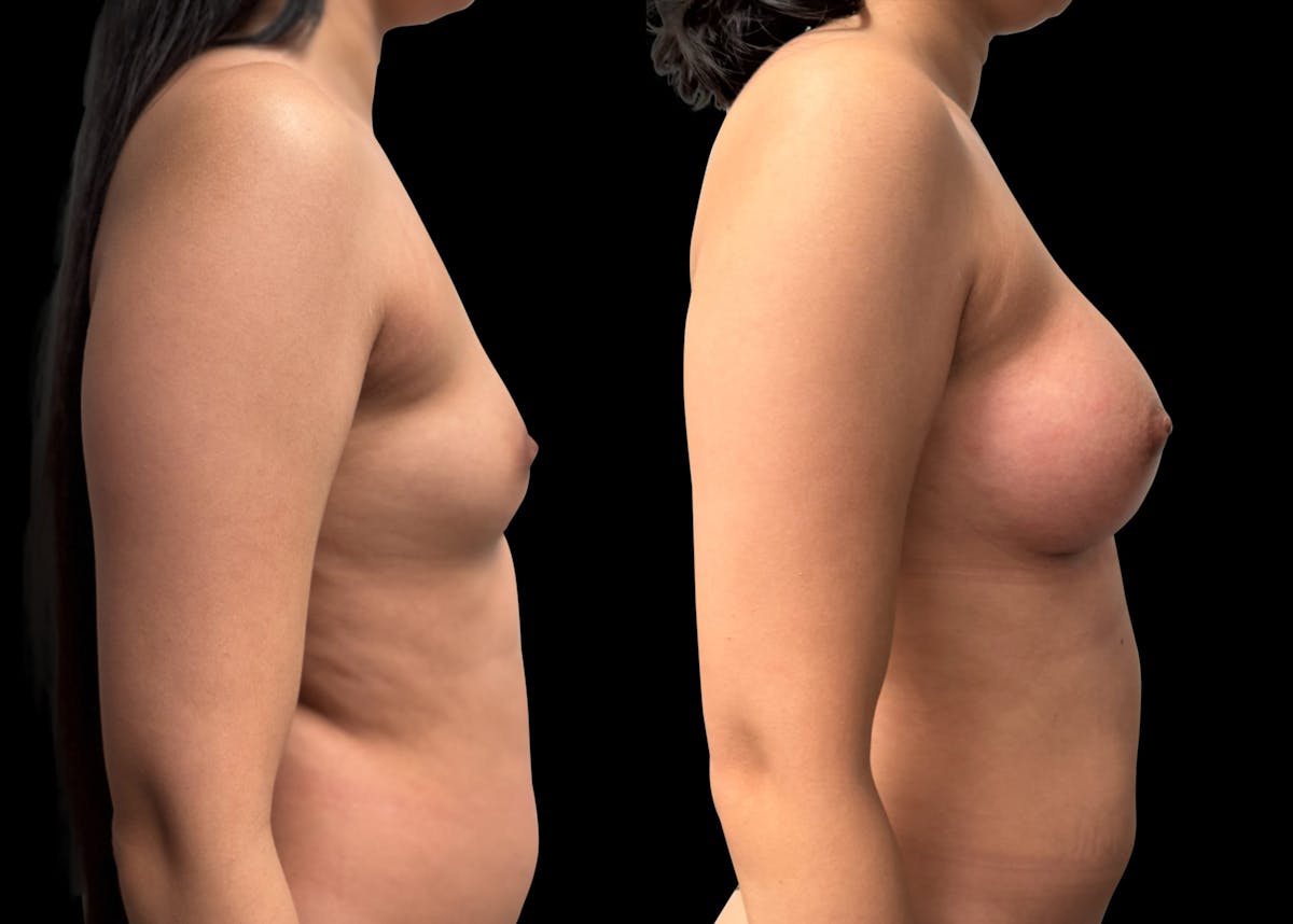 Breast Augmentation Before & After Gallery - Patient 946053 - Image 5