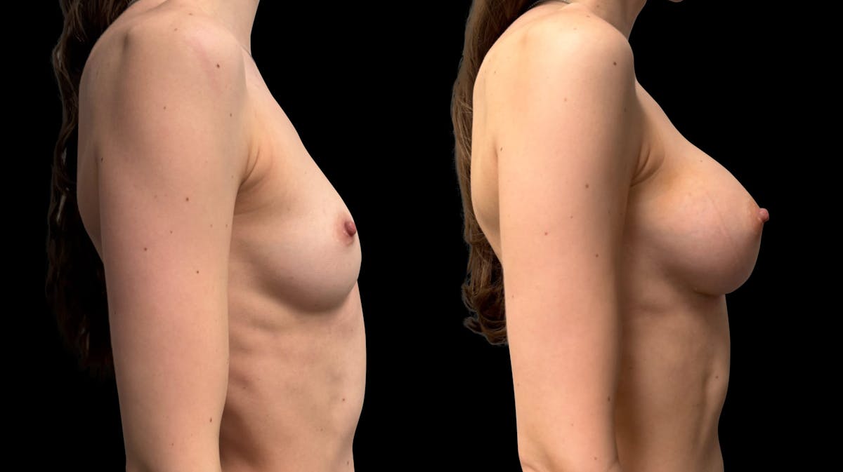 Breast Augmentation Before & After Gallery - Patient 444663 - Image 5