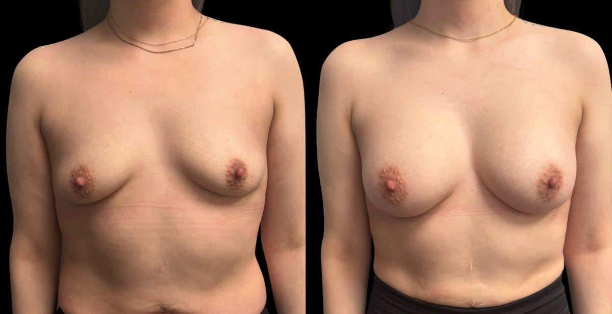 Breast Augmentation Before & After Gallery - Patient 705290 - Image 1