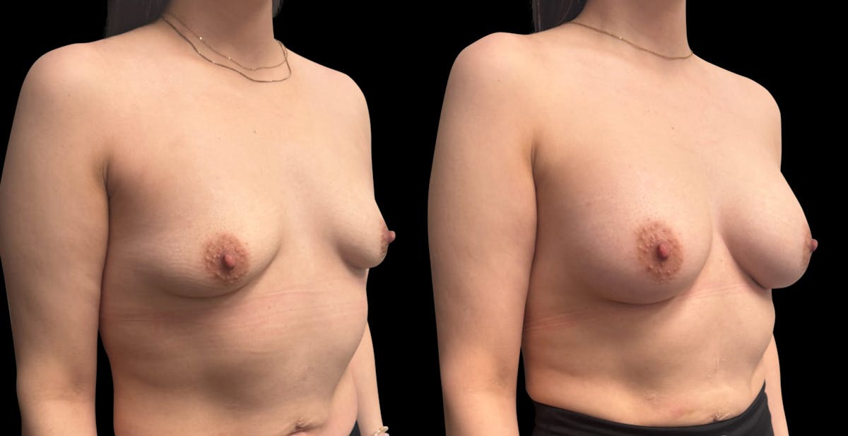 Breast Augmentation Before & After Gallery - Patient 705290 - Image 2