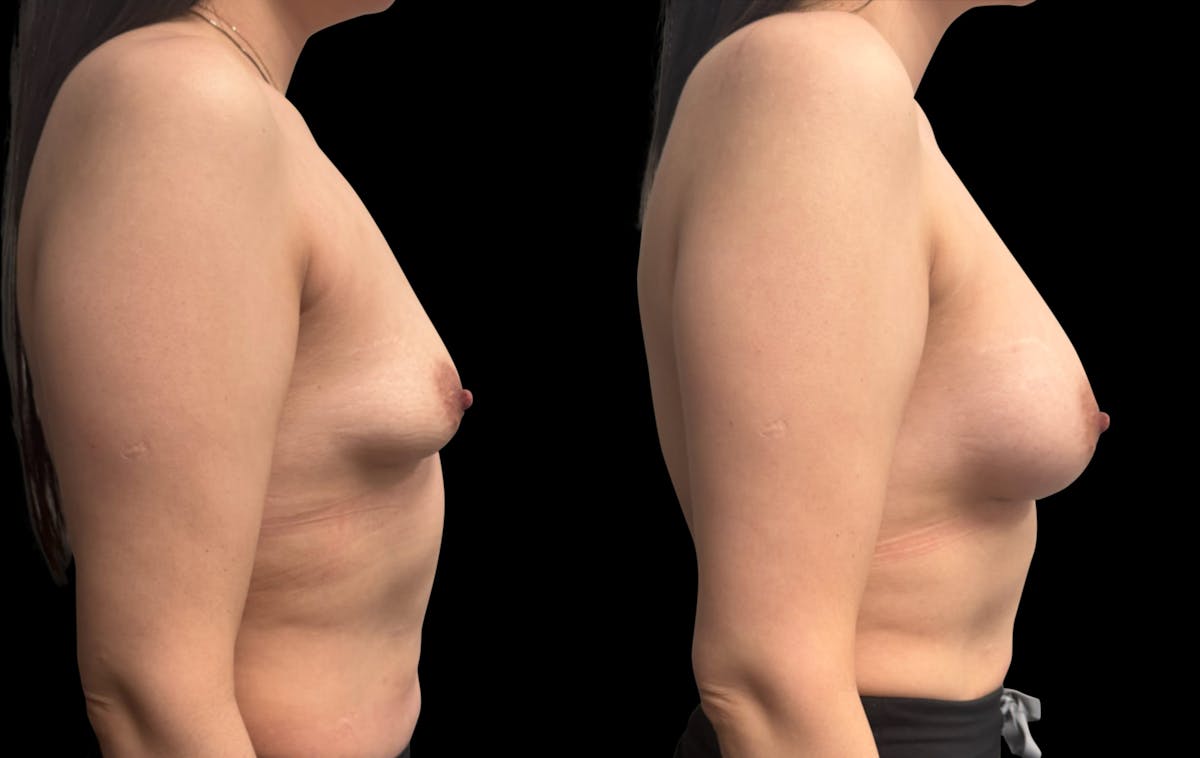 Breast Augmentation Before & After Gallery - Patient 705290 - Image 3