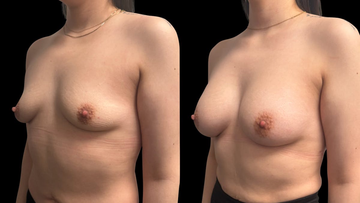 Breast Augmentation Before & After Gallery - Patient 705290 - Image 4