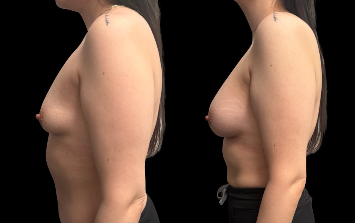 Breast Augmentation Before & After Gallery - Patient 705290 - Image 5