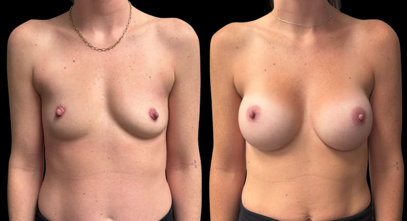 Breast Augmentation Before & After Gallery - Patient 150963 - Image 1